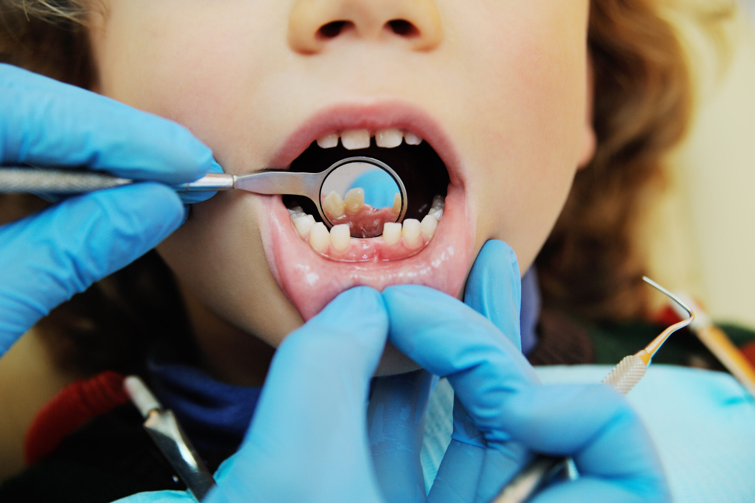 Tandpijn bij uw kind: wanneer is het een spoedgeval?